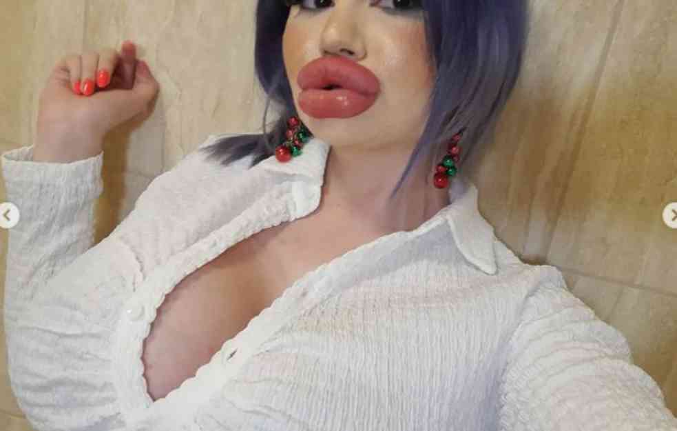 OČAJNA! ŽELI DA IZGLEDA KAO LUTKA! Žena sa najvećim usnama na svetu zakazala 27. tretman (FOTO)