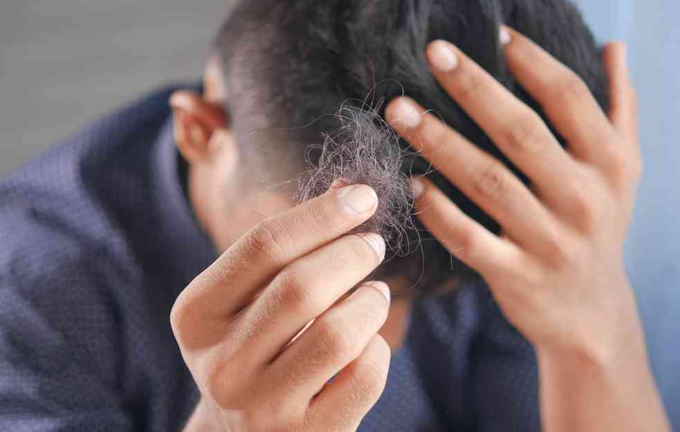 KAKO SE LEČI ALOPECIJA : Da li postoji lek i šta je važno znati!
