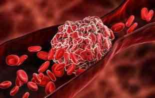 <span style='color:red;'><b>Istraživači</b></span> pronašli mikroplastiku u naslagama masti uklonjenih iz arterija