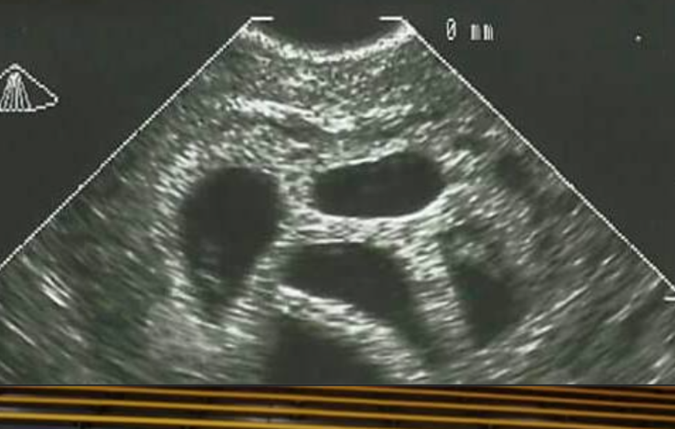 Doktor video petorke na ultrazvuku, savetovao majku na abortus: 20 godina kasnije objavila je