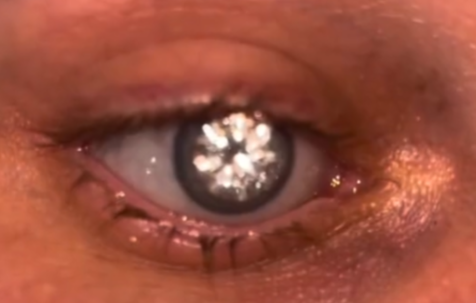 Mladić sa DIJAMANTOM u oku postao zvezda društvenih mreža