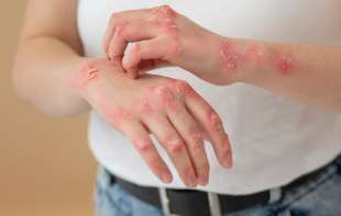 Svetski dan borbe protiv psorijaze: U Srbiji oko 140.000 obolelih