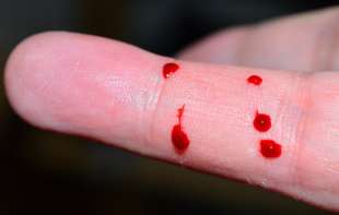 Ovo su znakovi da imate začepljenje arterije